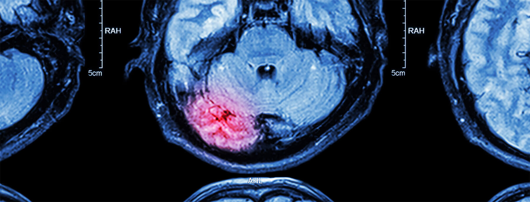 Lesiones Cerebrales